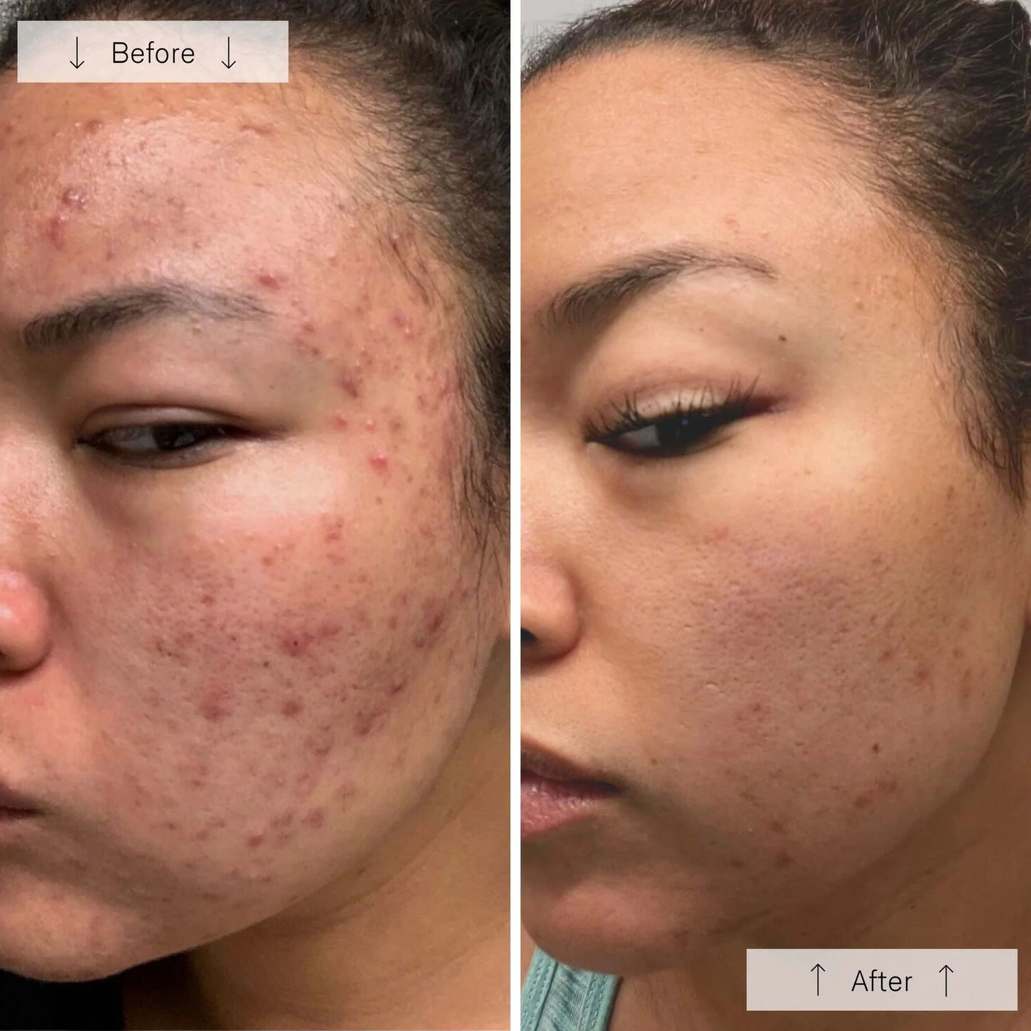 Omnilux Clear Face Mask