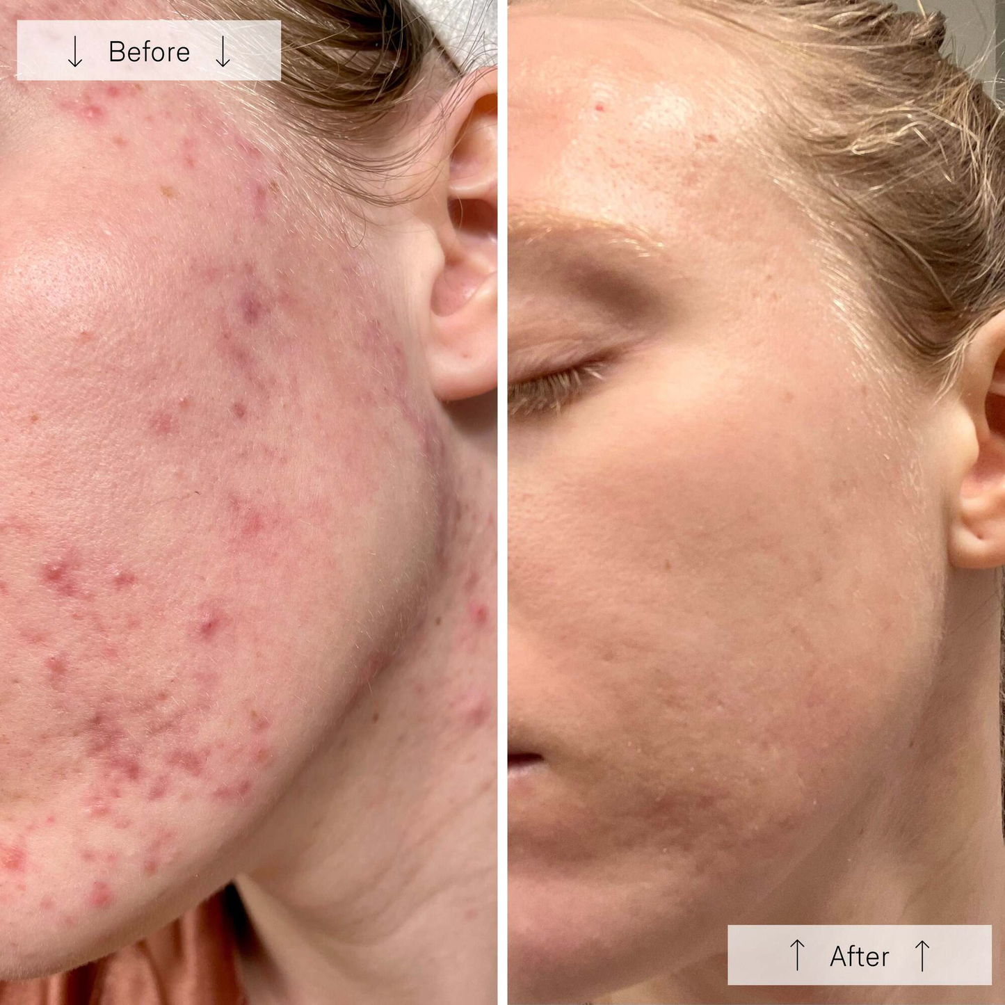 Omnilux Clear Face Mask
