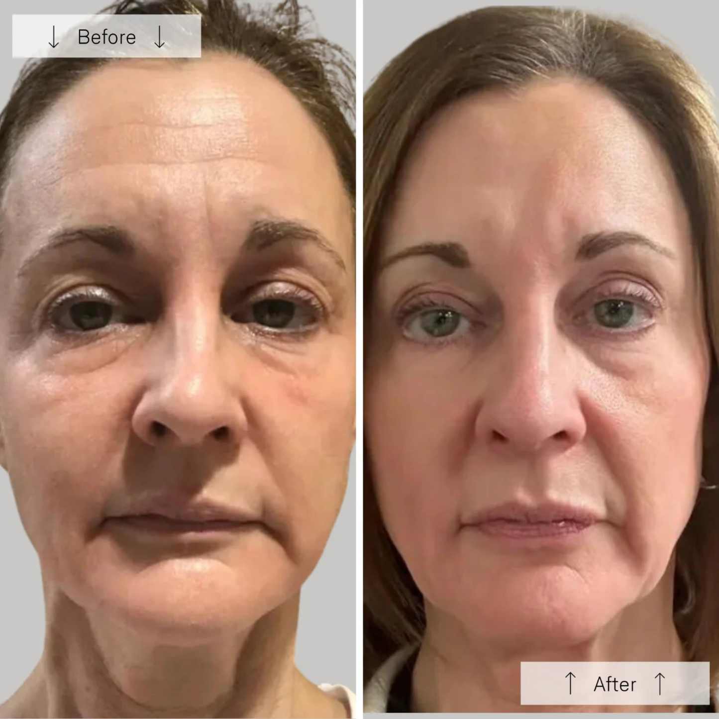 Omnilux Contour Face Mask