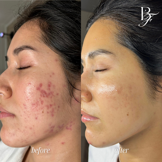 Face Reality acne treatment Cincinnati