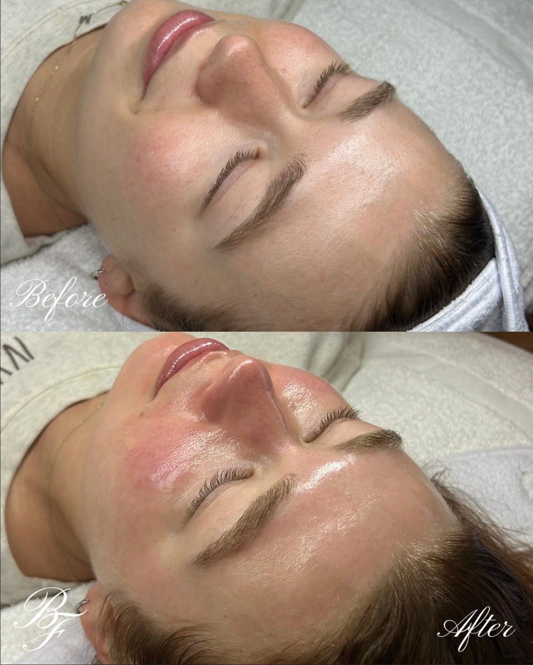 Before and after HydraFacial results showing clearer, more hydrated skin